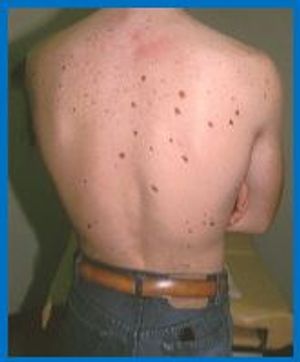Multiple Nevi on a Young Man