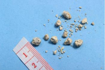 empagliflozin reduces incidence of kidney stones