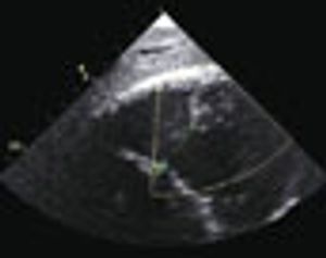 Ventricular Septal Defect Following Myocarditis