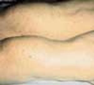 Systemic Lupus Erythematosus