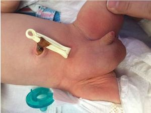 Hemiscrotal Bulge in an Otherwise Normal Neonate