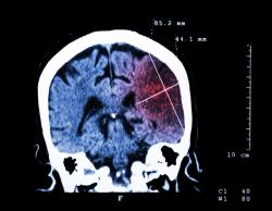 Statin Treatment and Duration Associated with Reduced Risk of Hemorrhagic Stroke 