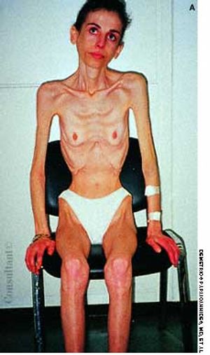 Anorexia Nervosa