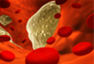 Hyperlipidemia: How to Optimize Risk While Waiting for NCEP ATP IV Guidelines