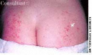 Contact Dermatitis to Diaper Material