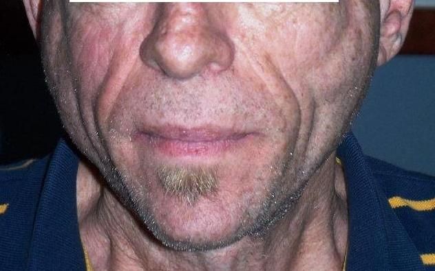 Parotid Gland Deformities In Hiv Seropositive Patients The Best Choice For Cosmetic Control