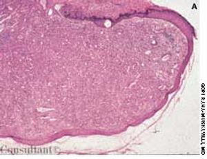 Bacillary Angiomatosis
