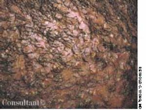 Folliculitis Decalvans