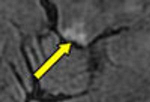 Non-Alcoholic Wernicke Encephalopathy