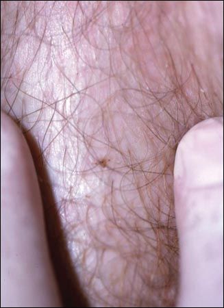 What's responsible for pubic itching in this patient?