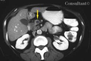 Superior Mesenteric Vein Thrombosis and Abdominal Pain