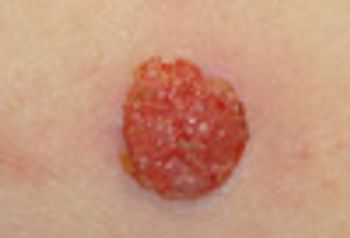 Seborrheic keratosis