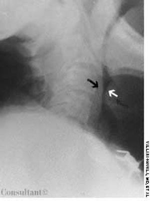 Acute Epiglottitis