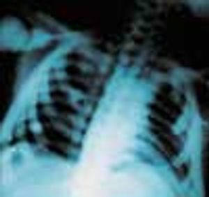 Osteopetrosis