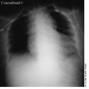 Aortic Dissection