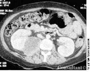 Psoas Abscess