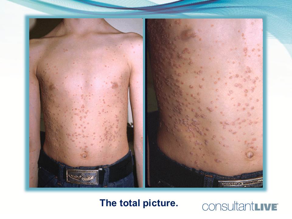 A Young Male with a Rash of Scales