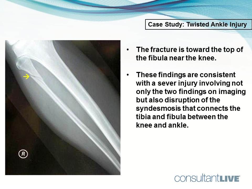 Maisonneuve injury of the ankle 