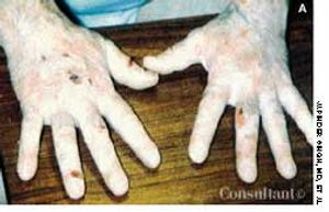 Porphyria Cutanea Tarda in a Middle-Aged Man