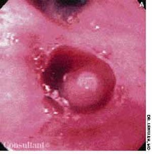 Squamous Cell Carcinoma of the Lung