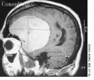 Meningioma