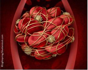 Stroke Prevention in AF: What are Your Options?