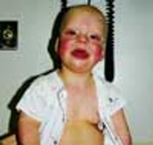 Beckwith-Wiedmann Syndrome
