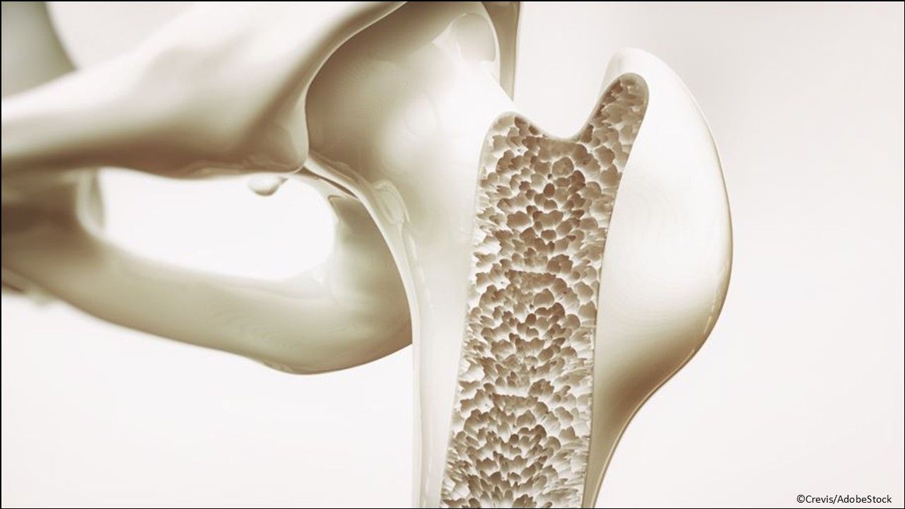 Osteoporosis: Denosumab-dssb (Ospomyv) injection