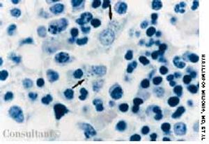 Atypical Presentation of Visceral Leishmaniasis