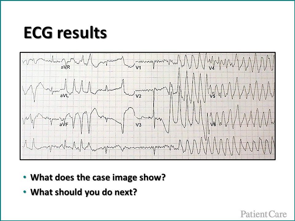 Torsade de pointes, ventricular tachycardia 