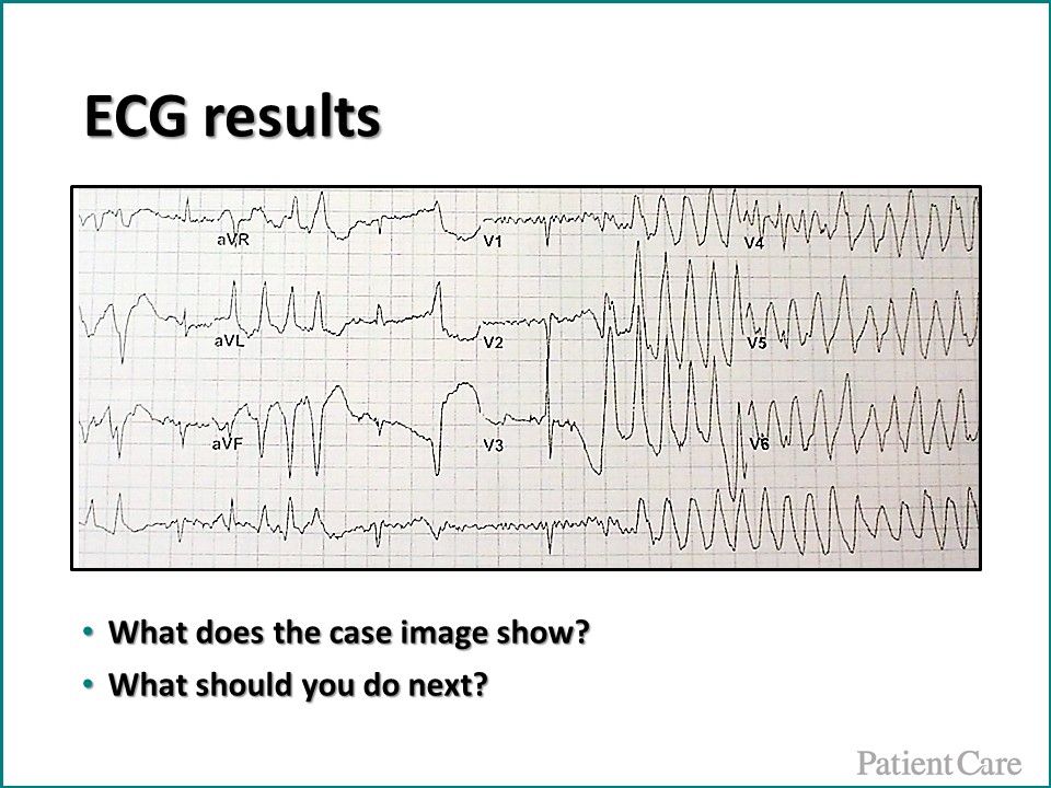 Torsade de pointes, ventricular tachycardia