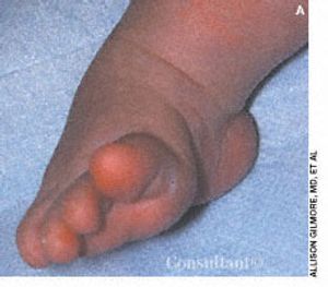 Congenital Clubfoot