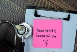 Early Biologic Therapy for Hidradenitis Suppurativa Supported by Majority of Specialists, Survey Shows
