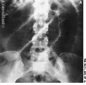 Cytomegalovirus Infection