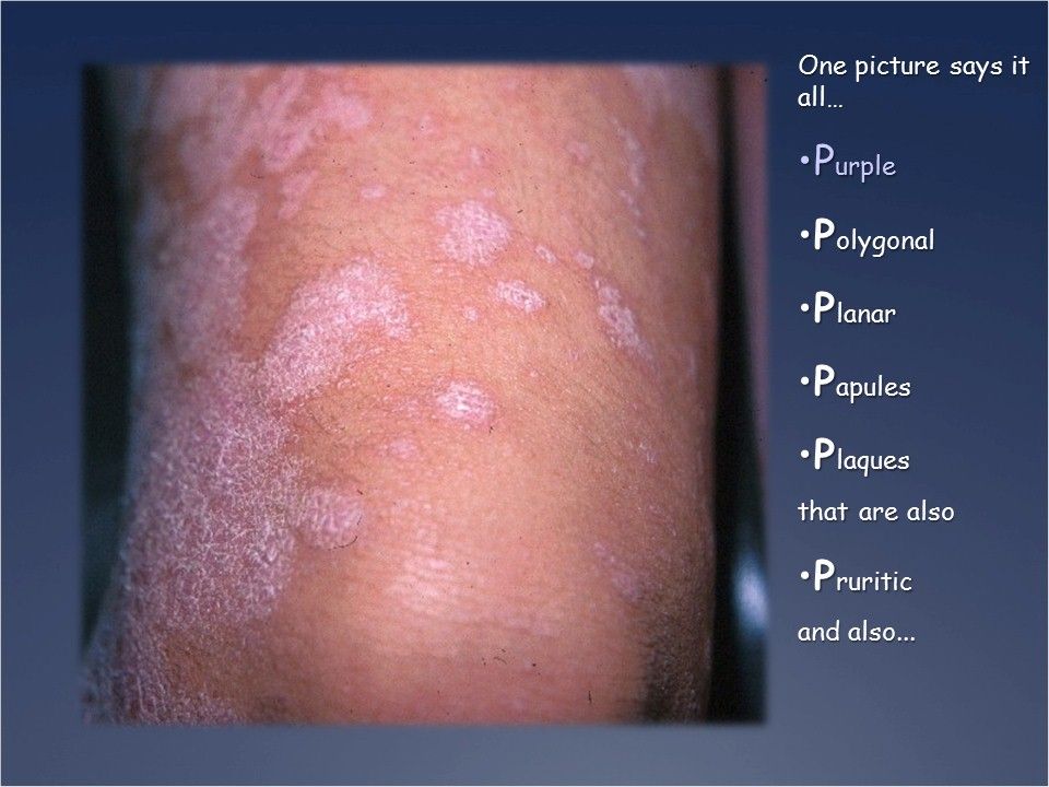 A Pruritic, Polygonal, Papular, Rash on a 10-year-old Boy