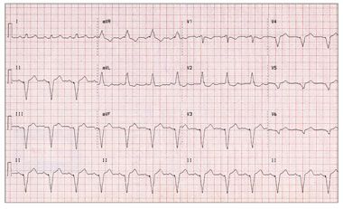 Too Much For The Computer Complete Heart Block In An Elderly Woman