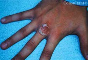 Verruca Recurrence
