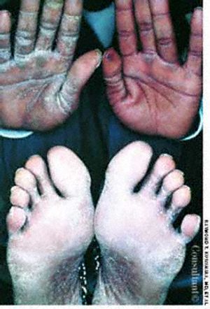 Two Feet - One Hand Syndrome