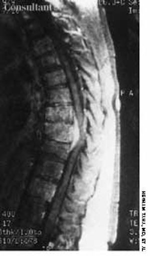 Spinal Cord Compression