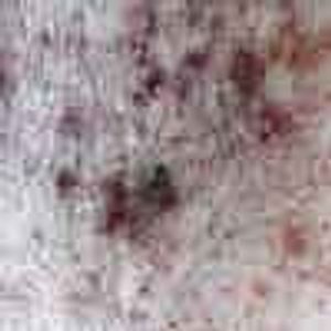 Mycosis Fungoides