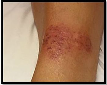 Necrobiosis lipoidica