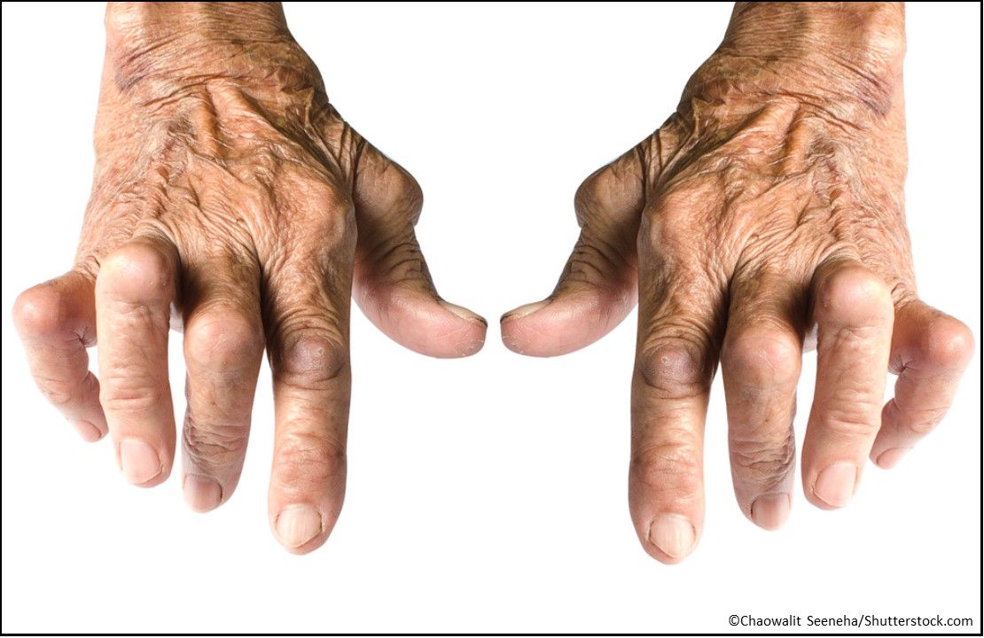 Rinvoq (upadacitinib) Extended-Release Tablets for rheumatoid arthritis