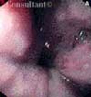 Banding of Bleeding Esophageal Varices