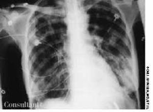 Pulmonary Tuberculosis