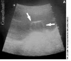 Orthotopic Ureterocele