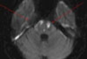 Cocaine-Induced Stroke