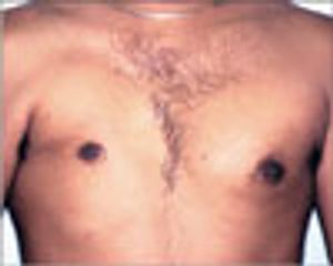 Pectoralis Major Agenesis (Amyoplasia) in a Young Man