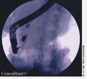 Pancreatic Carcinoma