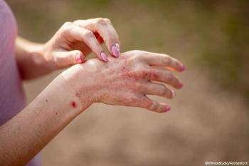 FDA Grants Fast Track Designation to Rezpegaldesleukin for Atopic Dermatitis / Image credit: ©InfiniteStudio/AdobeStock