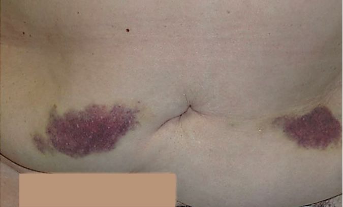 Abdominal Ecchymosis Abdominal Ecchymosis